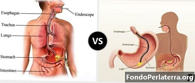 Endoskopija vs. Gastroskopija
