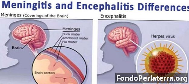 Meningitis vs. Encefalitis