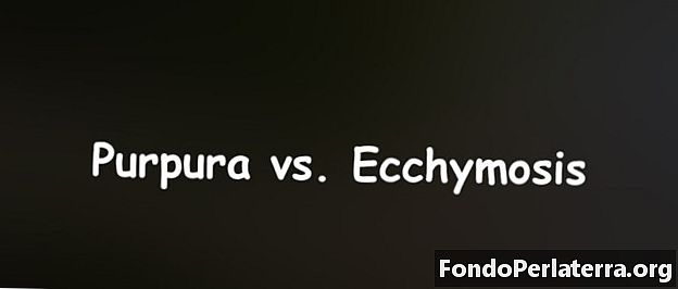 Purpura vs. ecchymosis