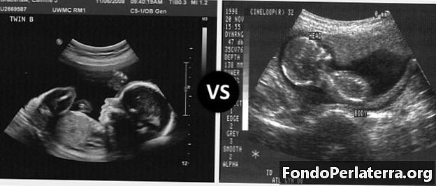 Sonogram vs. ultralyd
