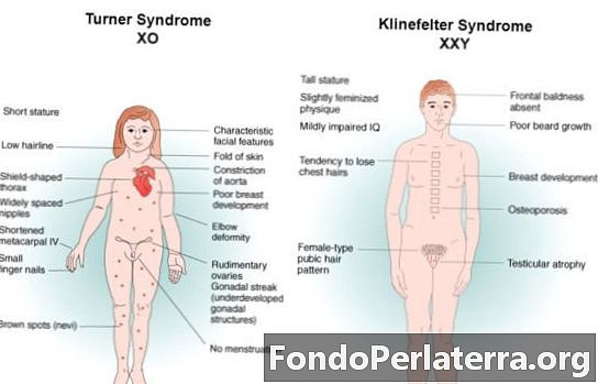 Turnerio sindromas vs. Klinefelterio sindromas