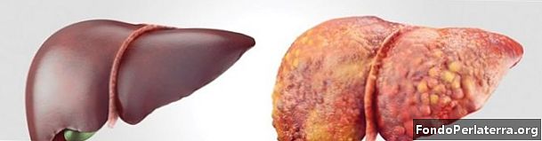 Hepatitt vs. gulsott